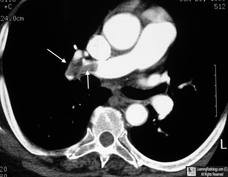 Pulmonary embolism